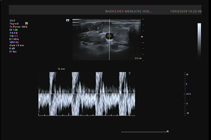 Siêu âm doppler có thể phát hiện xơ vữa động mạch cảnh