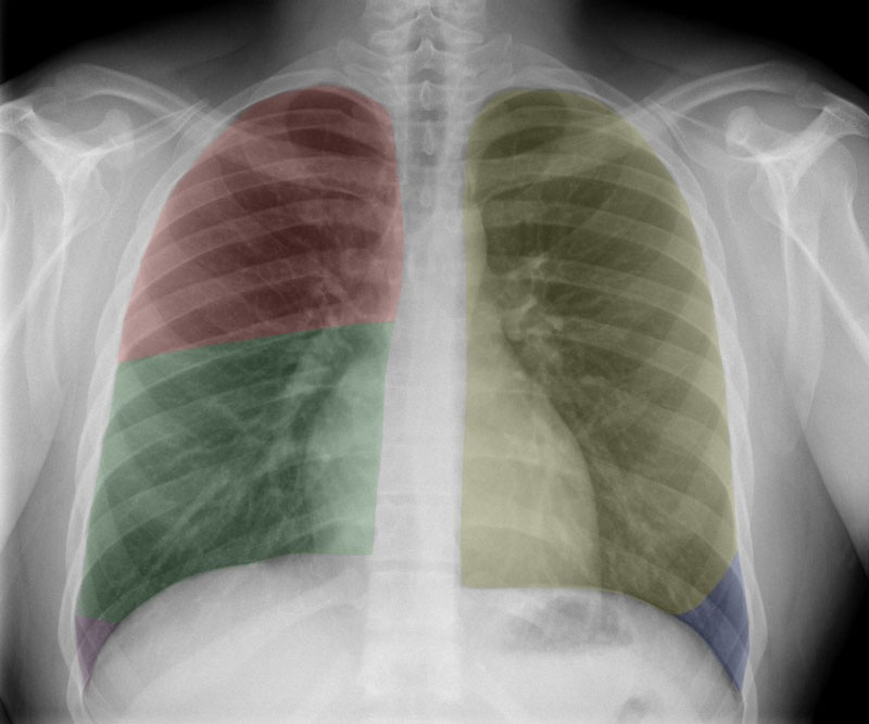 Chụp X-quang phổi để phát hiện những bất thường về tim, phổi, các mạch máu