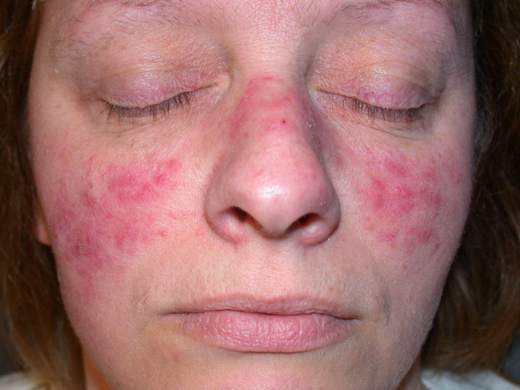 Hội chứng Lupus ban đỏ hệ thống