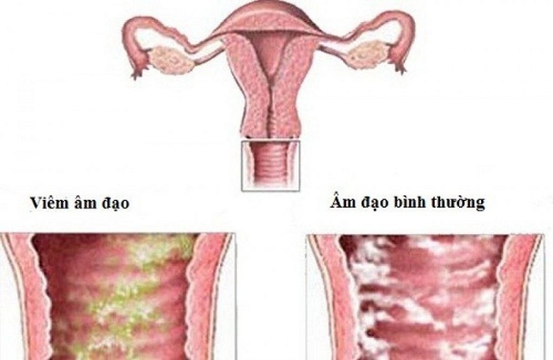 Hình 1: Viêm âm đạo do nấm là nỗi lo thầm kín của nhiều chị em phụ nữ. 