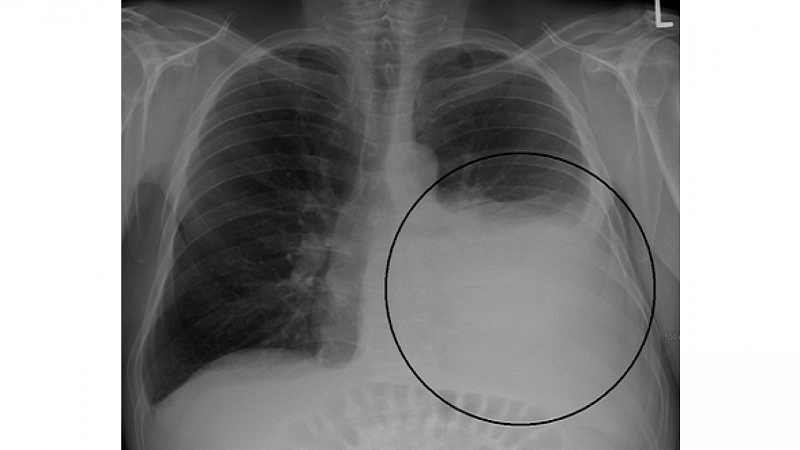 Hình 4: Hiện tượng tràn dịch màng phổi trên phim chụp X-quang.