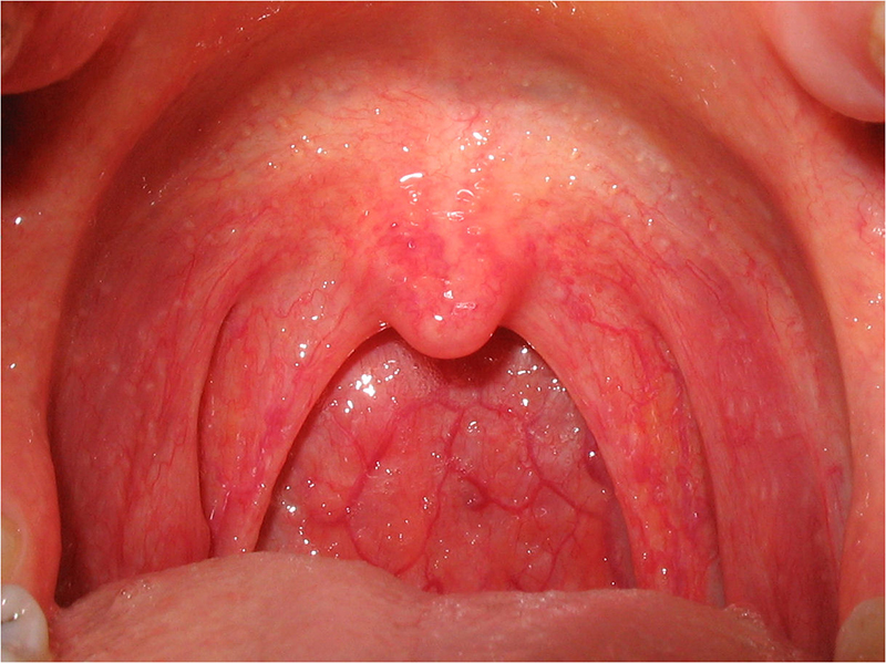 Niêm mạc họng và hầu bị sưng đỏ là triệu chứng của bệnh