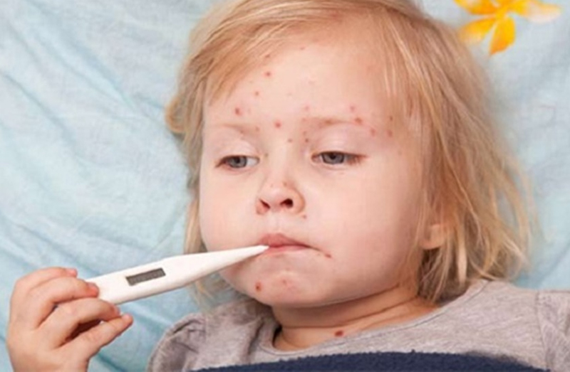 Khi bị mắc bệnh sởi, trẻ em thường sẽ bị sốt cao và mọc các vết ban đỏ.