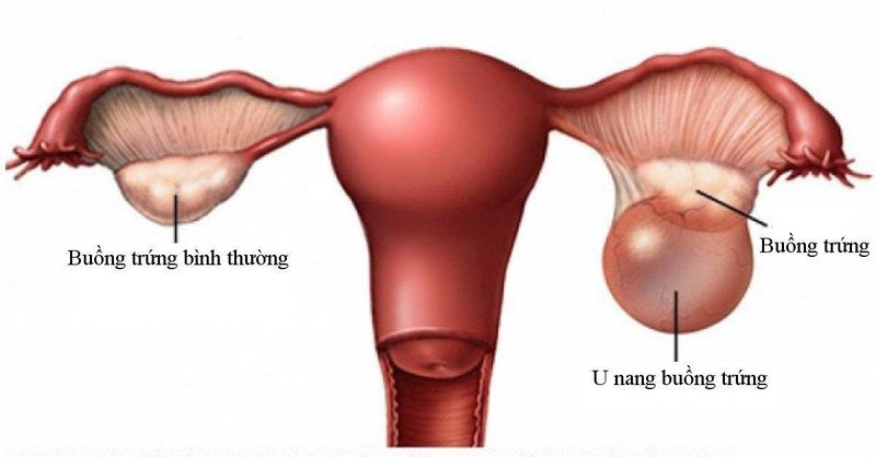 Hình ảnh minh họa u nang buồng trứng