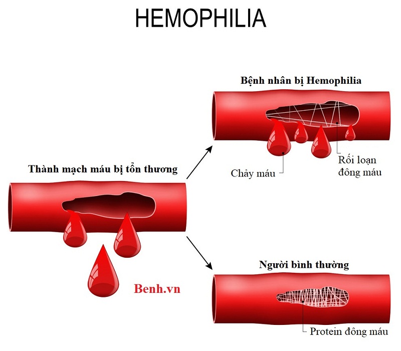 Bệnh máu khó đông Hemophilia hay còn gọi là bệnh ưa chảy máu