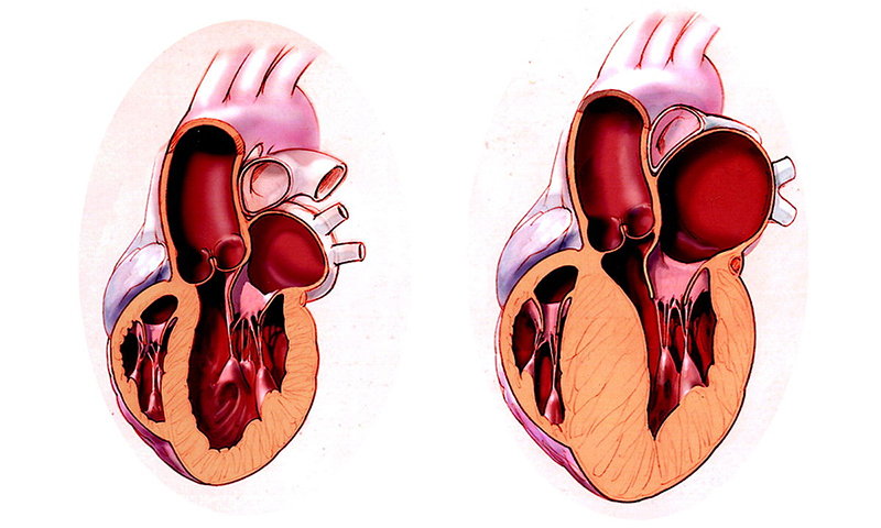 EF lớn hơn 75% là cảnh báo nguy cơ mắc chứng phì đại cơ tim
