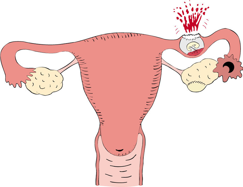 Đau vùng bụng dưới và chậm kinh hoặc ra máu âm đạo bất thường có thể là biểu hiện mang thai ngoài tử cung