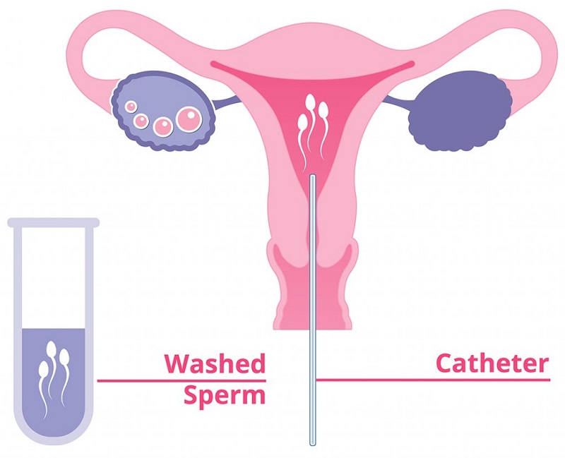 Hình ảnh mô tả quy bơm tinh trùng vào buồng tử cung 