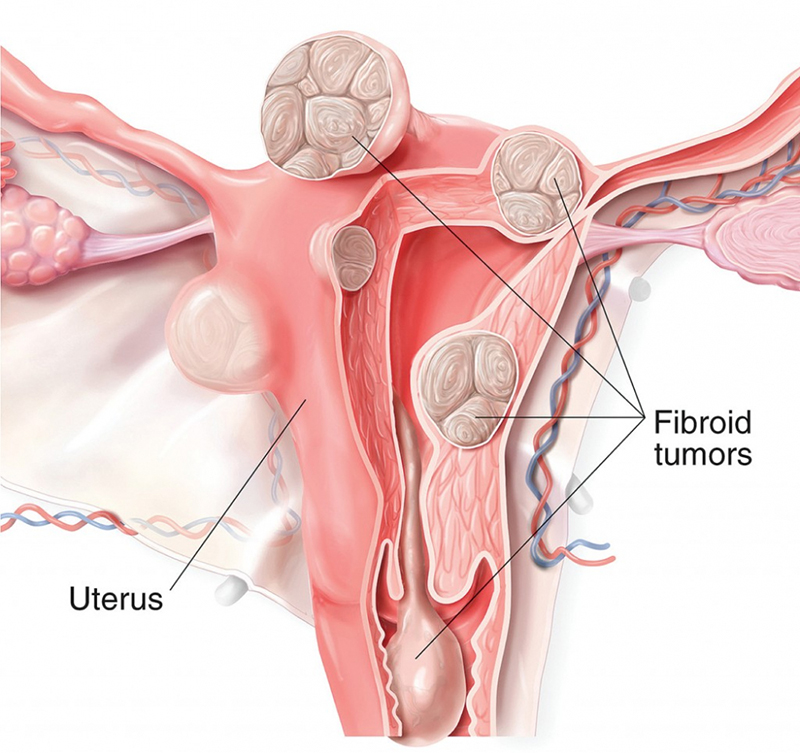Các khối u hình thành và phát triển bất thường trong buồng trứng