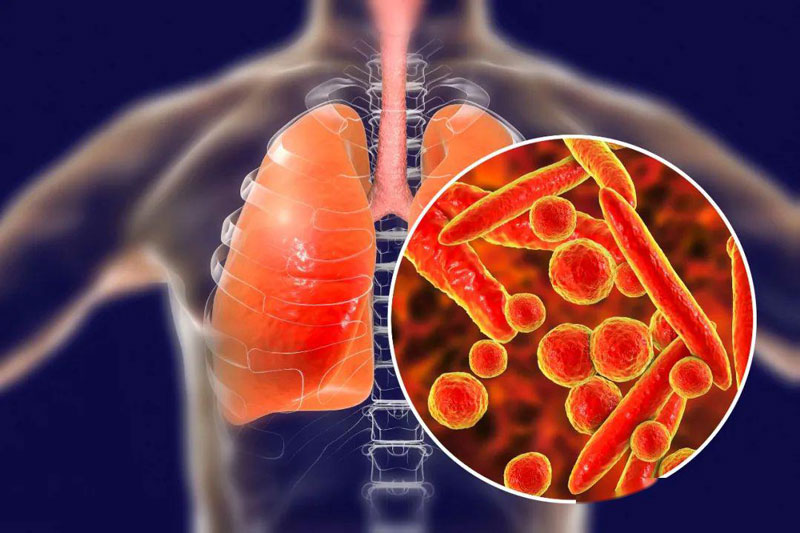 Lao phổi là một trong những bệnh rất nguy hiểm.