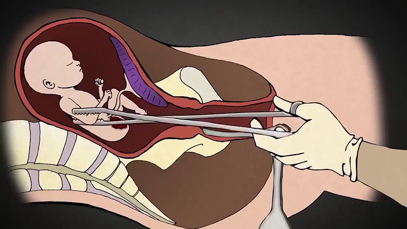 Phương pháp nong - nạo gắp thai có thể áp dụng đối với thai nhi đã quá lớn