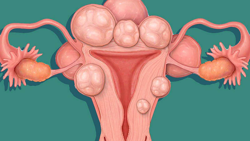 Các khối u xơ mọc ở nhiều vị trí khác nhau trên tử cung