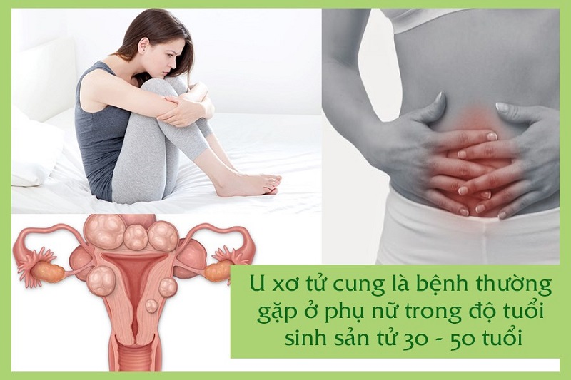 Người mắc u xơ tử cung thường xuyên bị đau vùng bụng dưới
