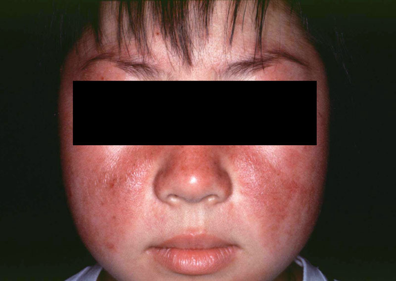 Bệnh nhân lupus dễ nổi phát ban sau khi tiếp xúc tia UV