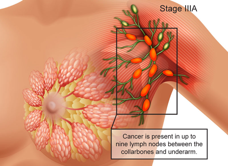 Hạch ở nách xuất hiện khi bệnh nhân mắc ung thư vú.