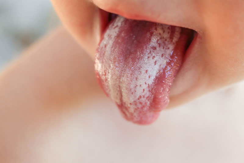 Khi trẻ bị tưa lưỡi có rất nhiều đốm trắng xuất hiện trên bề mặt lưỡi.
