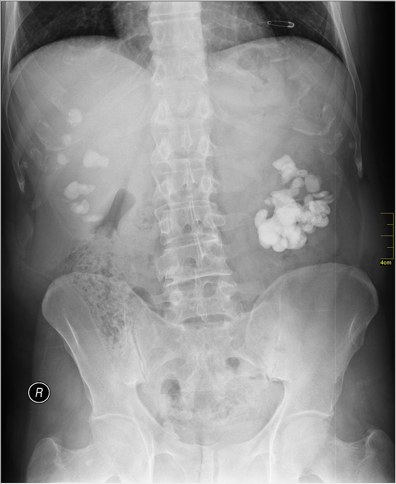 Hình ảnh X - quang của bệnh nhân sỏi thận