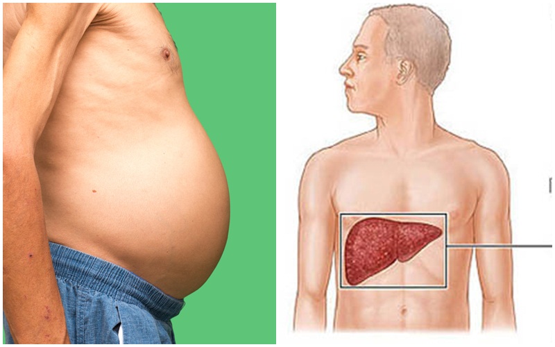 Hình 1: Xơ gan là một nguyên nhân phổ biến gây tràn dịch màng bụng