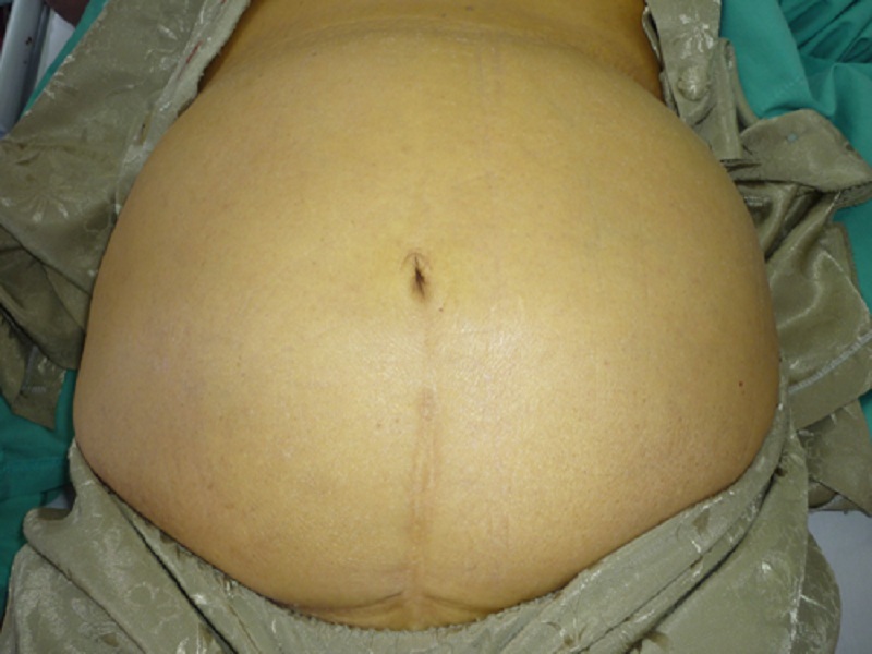 Hình 2: Bụng chướng to là biểu hiện đặc trưng của tràn dịch màng bụng.