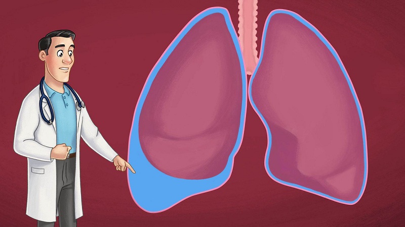 Hình 1: Hiện tượng tràn dịch màng phổi.