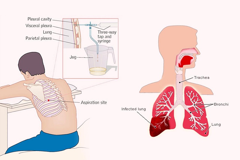 Hình 3: Chọc hút dịch màng phổi.