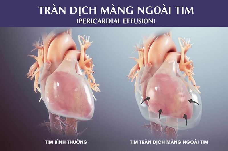 Hình 1: Tràn dịch màng ngoài tim