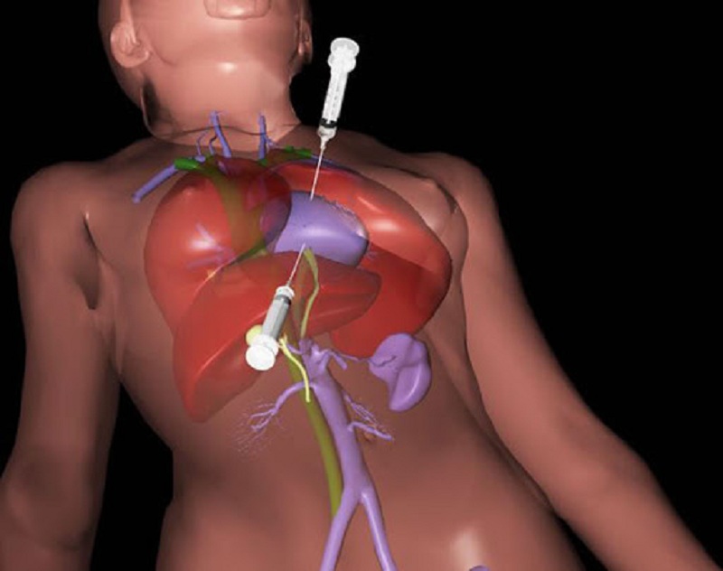 Hình 3: Kỹ thuật chọc hút dịch màng tim.