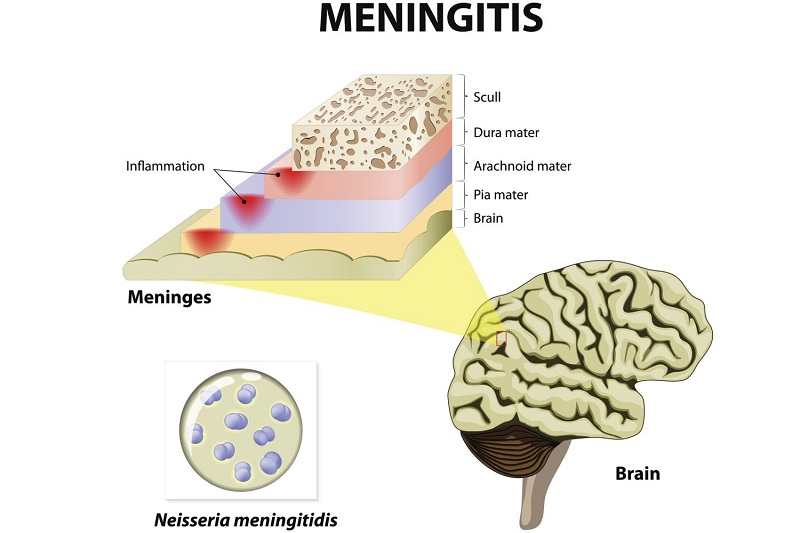 Hình 2: Não mô cầu Neisseria meningitidis là nguyên nhân gây viêm màng não rất nguy hiểm