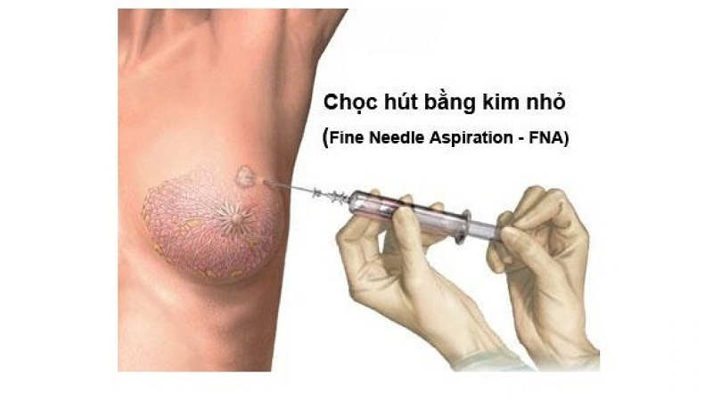 Hình 2: Kỹ thuật chọc hút bằng kim nhỏ khối u tại vú