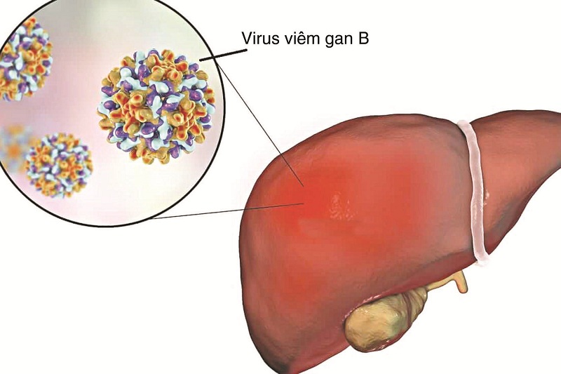 Hình 3: Viêm gan B là bệnh lý phổ biến trên thế giới.