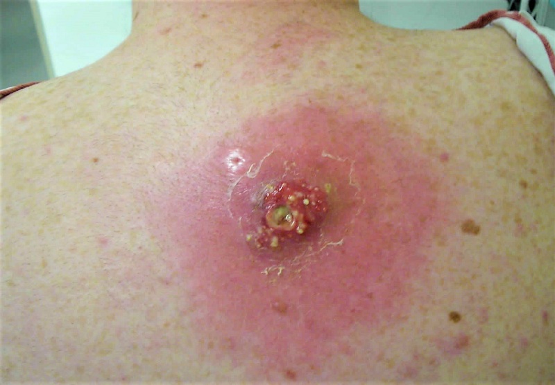 Hình 4: Nhiễm trùng vết thương do tụ cầu vàng Staphylococcus aureus