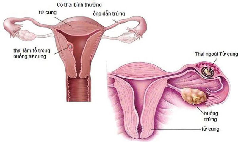 Người phụ nữ mang thai ngoài tử cung sẽ gặp hiện tượng ra máu khi mang thai.