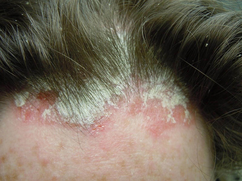 Hình ảnh bệnh nhân bị nấm da đầu do Trichophyton gây nên