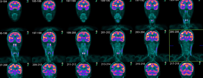 Chụp PET CT giúp phát hiện sớm khối u trong não
