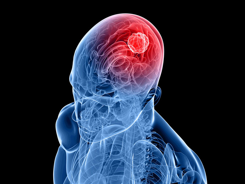 Ung thư não là căn bệnh có khối u ác tính nằm trong não