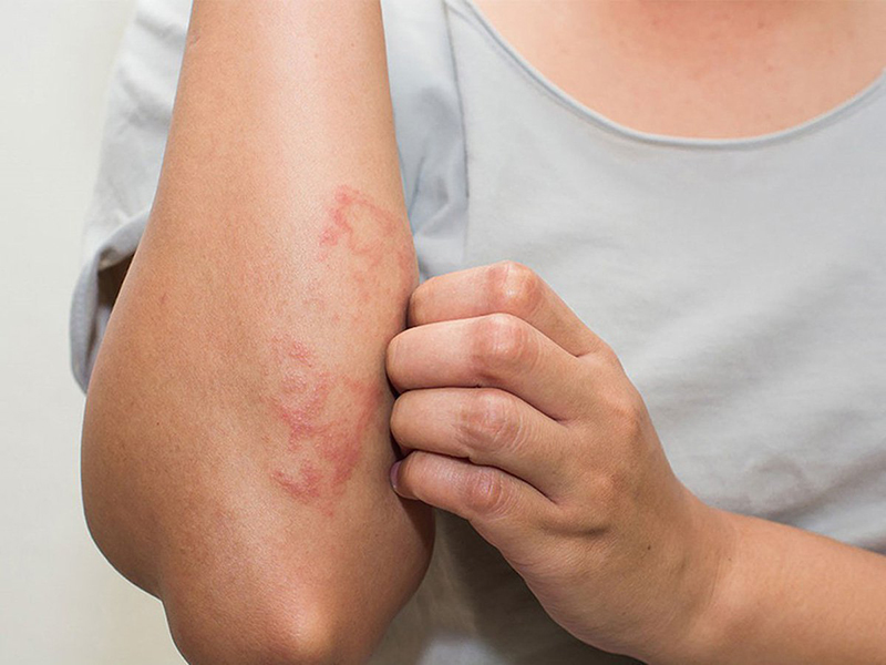 Bệnh nhân thường ngứa và gãi nhiều kèm những vùng tổn thương da
