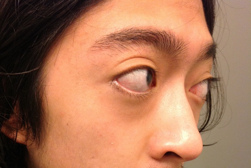 Hình 2: Mắt lồi là một trong những biểu hiện đặc trưng của bệnh tuyến giáp.