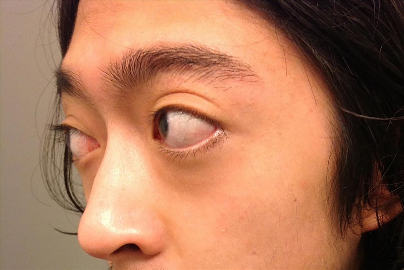 Hình 3: Một trong những biến chứng về mắt của Basedow.