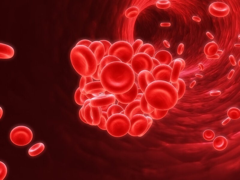 Hình 2: Hình ảnh đông máu rải rác trong lòng mạch