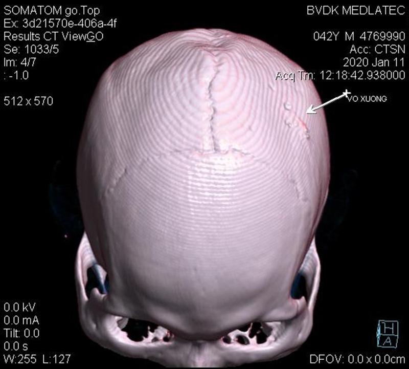 chụp CT cắt lớp não