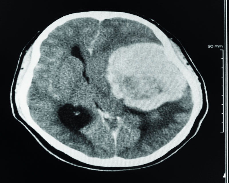 chụp CT cắt lớp não