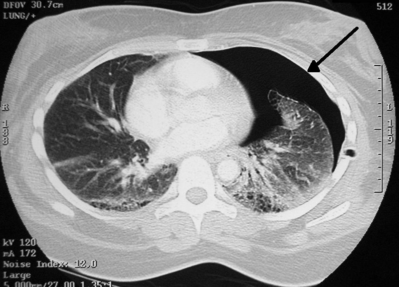 Chụp cắt lớp phổi