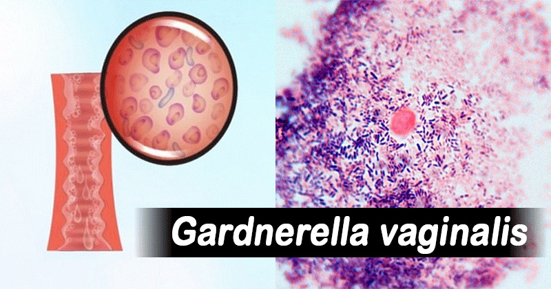 Gardnerella vaginalis nhuộm Gram