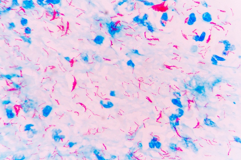 Hình ảnh 1:Mycobacterium tuberculosis khi nhuộm bằng phương pháp Ziehl-Neelsen.