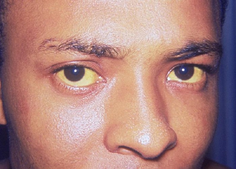 Bệnh nhân nhiễm viêm gan A có triệu chứng vàng mắt