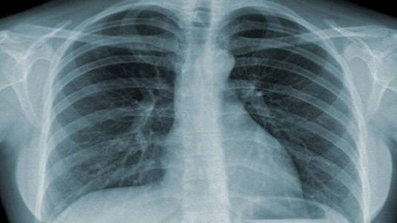 Chụp X-quang bệnh nhân viêm phổi (PCP)
