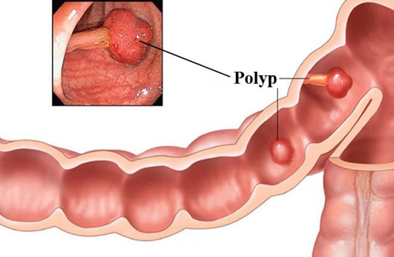 Bệnh polyp trực tràng
