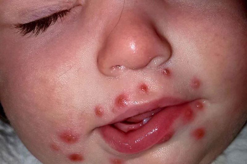 Các vết loét xung quanh miệng của trẻ bị bệnh 
