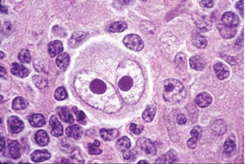 Hình 4: Hình ảnh tế bào trong u lympho hodgkin