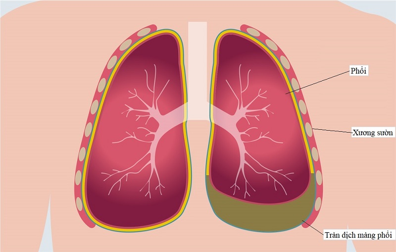 Hình ảnh tràn dịch màng phổi